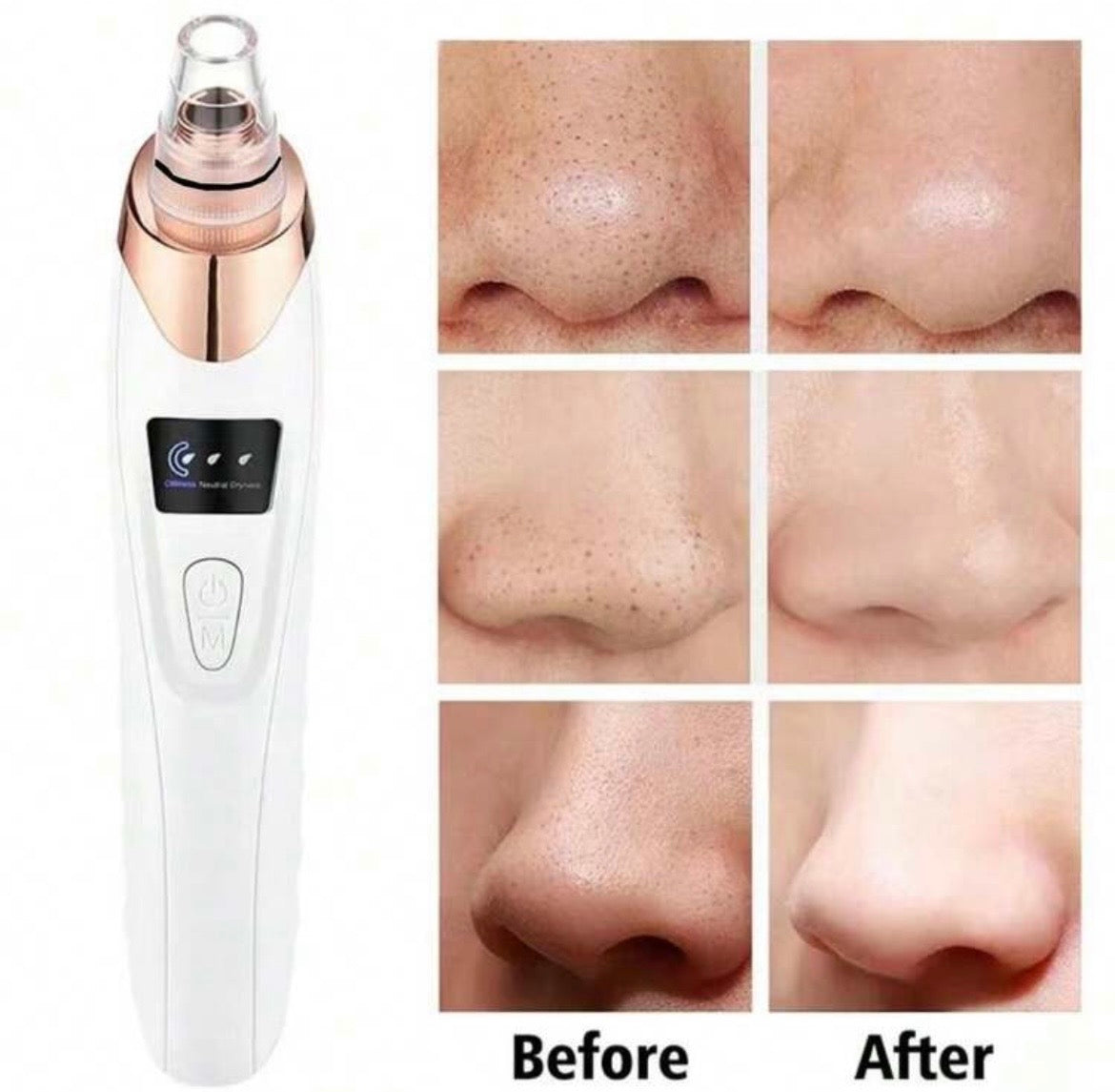 Blackhead remover and vacuum pore cleaner